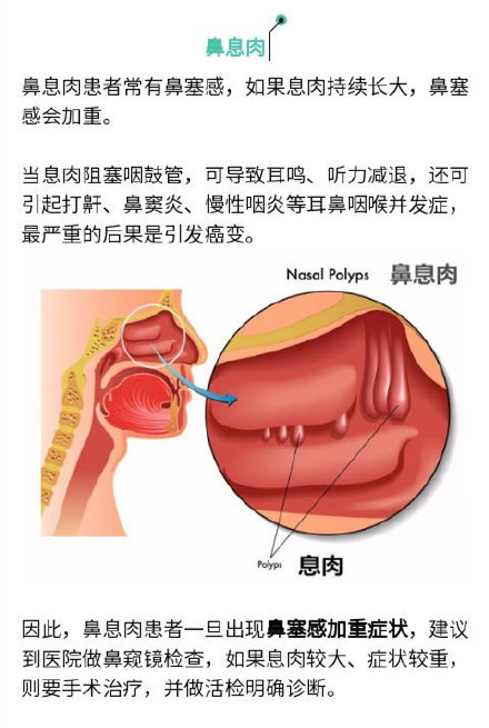 “息肉”离癌症有多远？肿瘤专家：这样的最危险