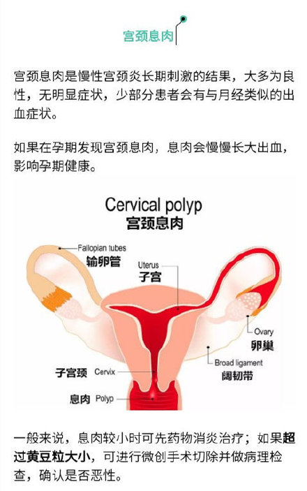 “息肉”离癌症有多远？肿瘤专家：这样的最危险