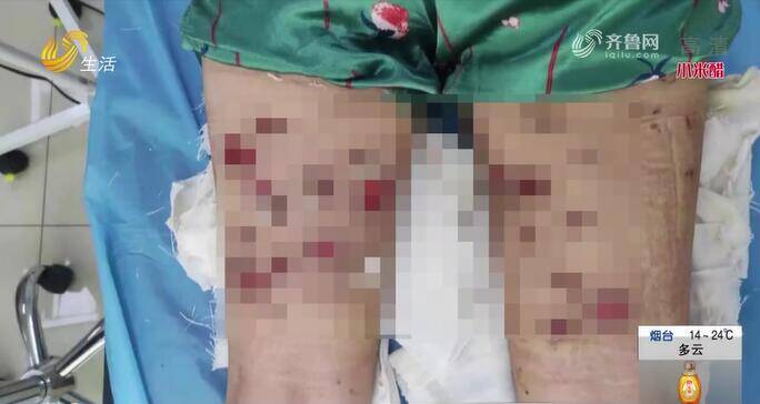 济宁一姑娘“注射减肥”致“皮肤溃烂”代理商转战临沂开加盟大会 四名组织者被警方控制