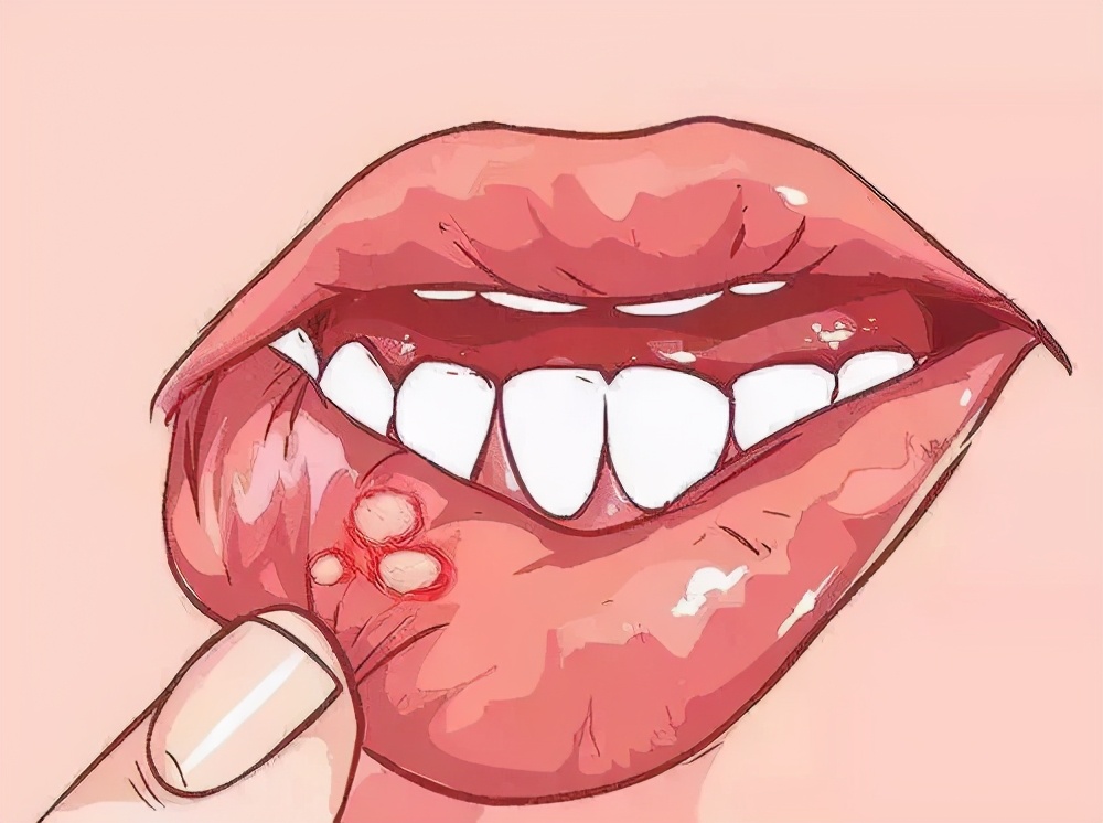 有一种痛,叫口腔溃疡,补充维C不顶用,这些办法才靠谱
