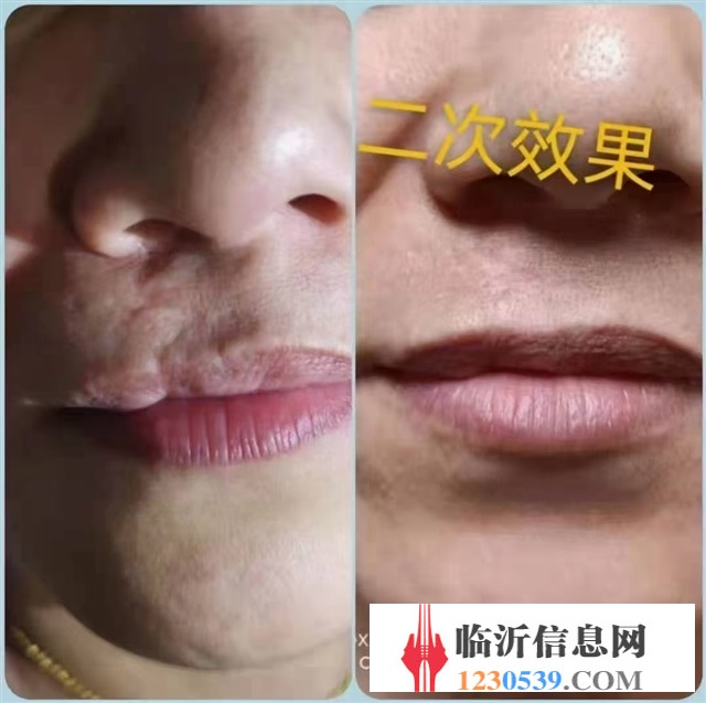 修复斑疤痘敏，各种问题性皮肤