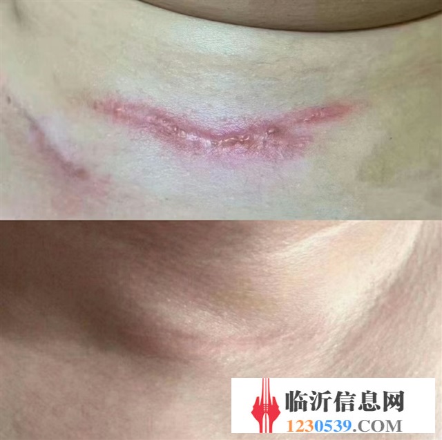 修复斑疤痘敏，各种问题性皮肤