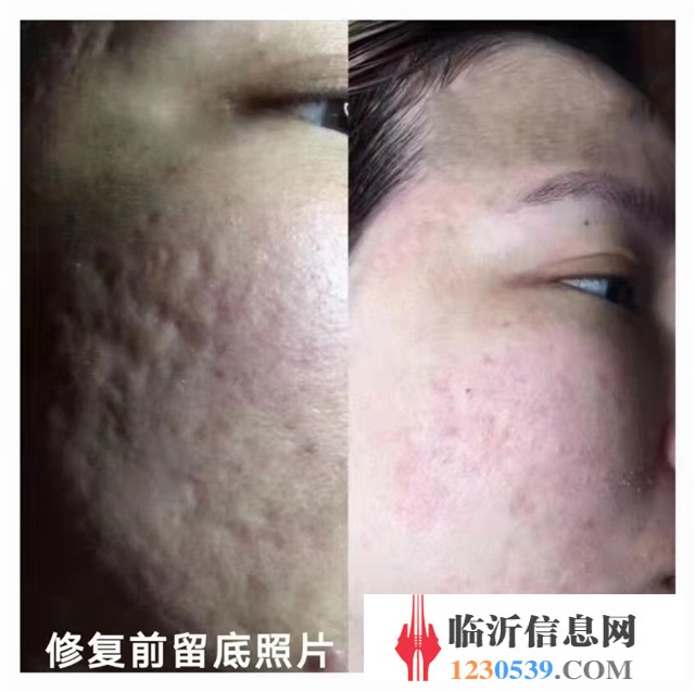 修复斑疤痘敏，各种问题性皮肤