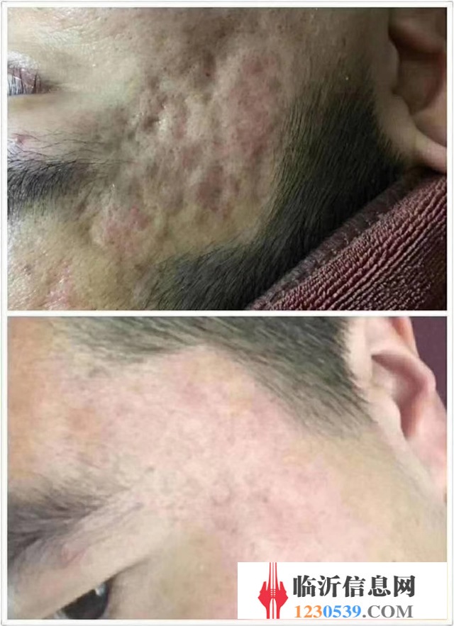 修复斑疤痘敏，各种问题性皮肤
