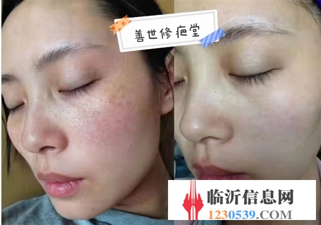 修复斑疤痘敏，各种问题性皮肤